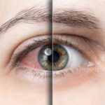 Síndrome do olho seco  aumenta no inverno